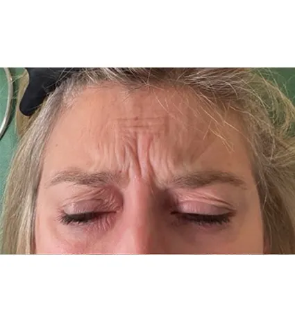 botox-pat-3-01