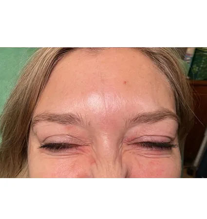 botox-pat-3-02