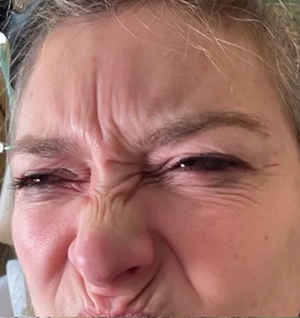 botox-pat-3-03