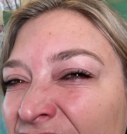 botox-pat-3-04