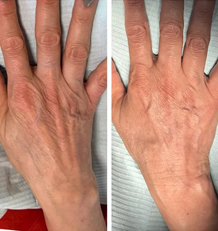 filler-hands-01
