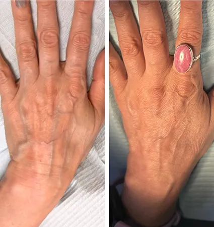 filler-hands-02