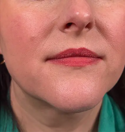 fillers-pat-A-02