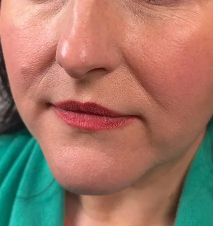 fillers-pat-A-04