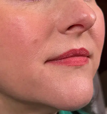 fillers-pat-A-06