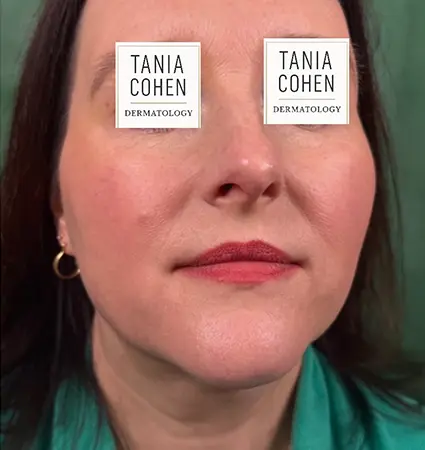 fillers-pat-A-10