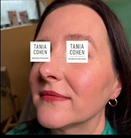 fillers-pat-A-14