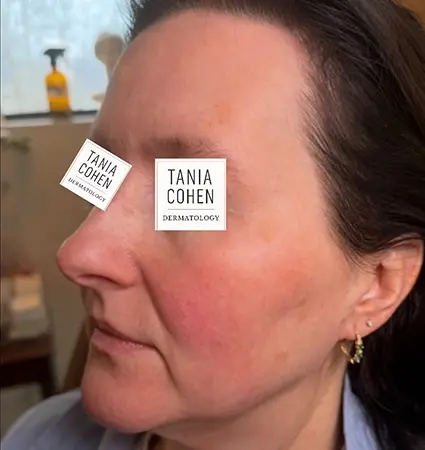 fillers-pat-A-15