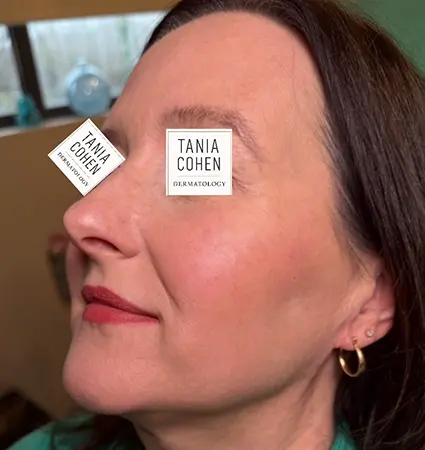 fillers-pat-A-18