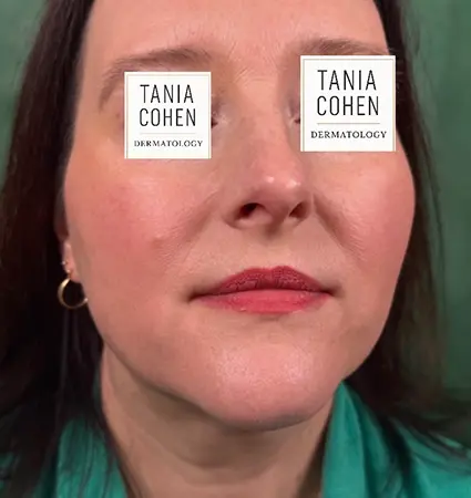 fillers-pat-A-20