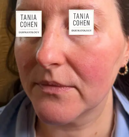 fillers-pat-A-21