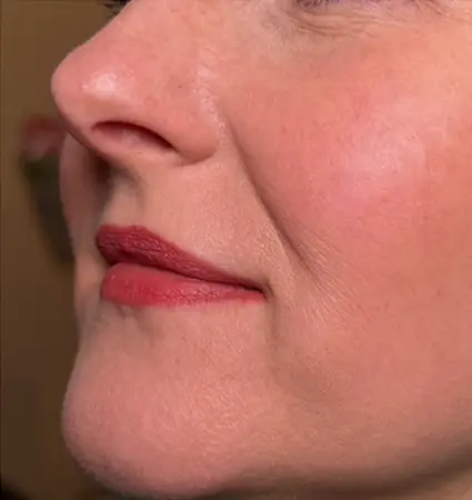 fillers-pat-A-24