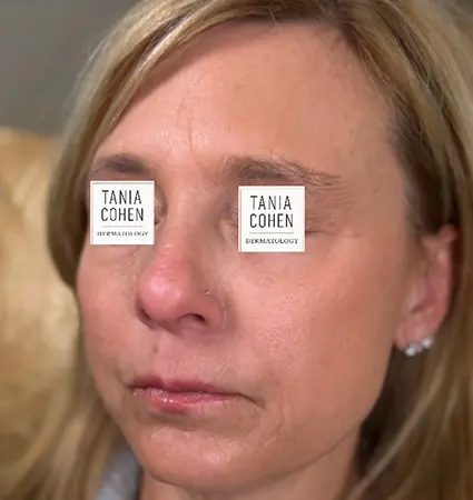 fillers-pat-c-10