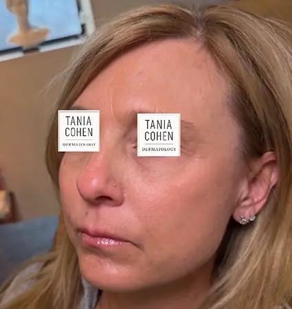fillers-pat-c-11