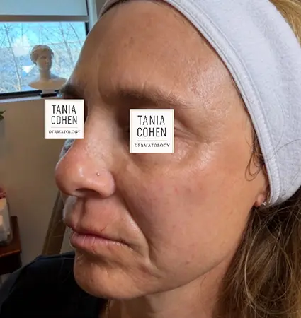 fillers-pat-c-12