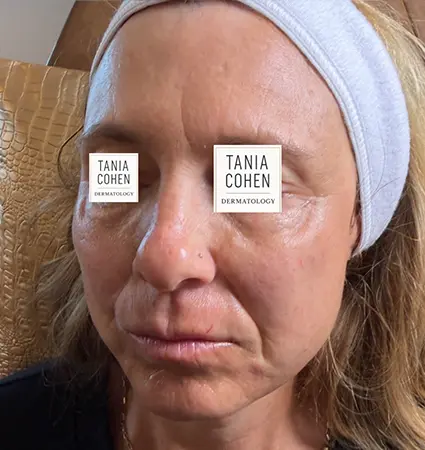 fillers-pat-c-13
