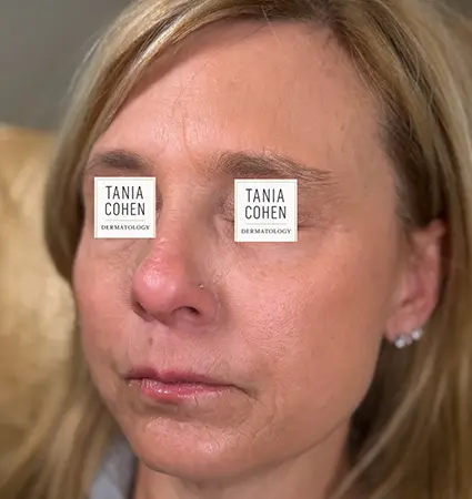 fillers-pat-c-14
