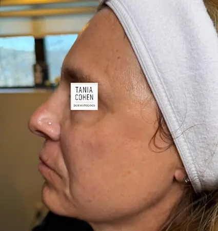 fillers-pat-c-15
