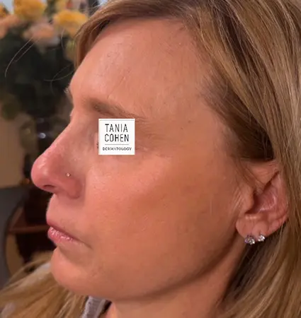 fillers-pat-c-16
