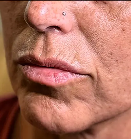 fillers-pat-d-01