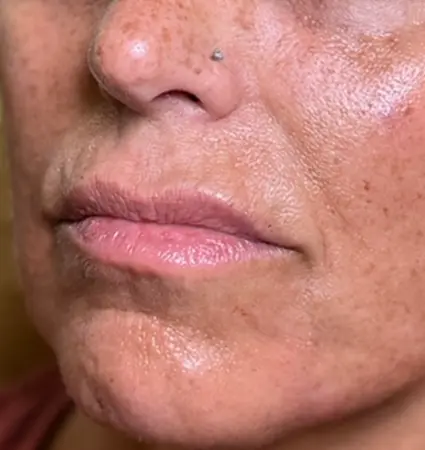 fillers-pat-d-02