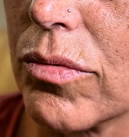 fillers-pat-d-03