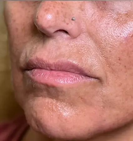 fillers-pat-d-04