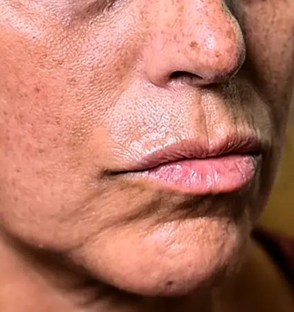 fillers-pat-d-05