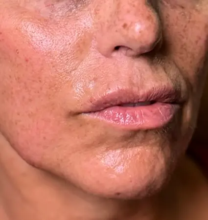 fillers-pat-d-06