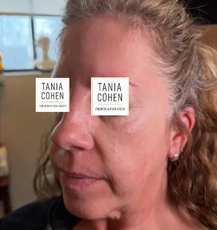 fillers-pat-e-05