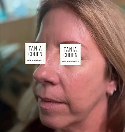 fillers-pat-e-06