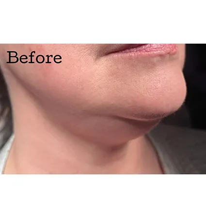 kybella-01