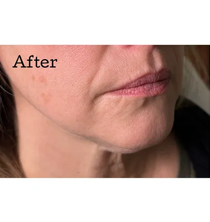 kybella-02