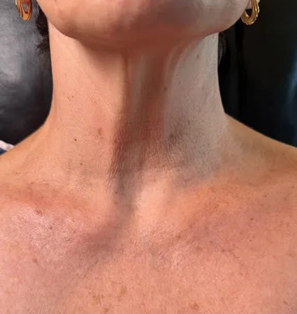 pdo-threads-neck-pat-A-01