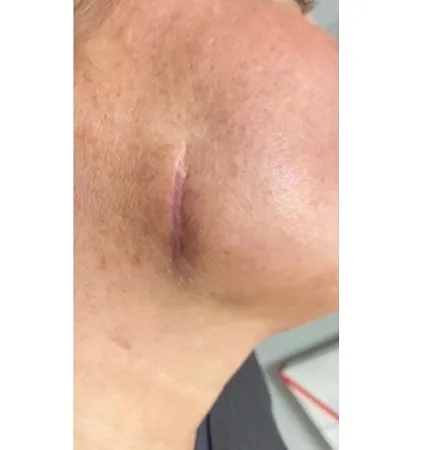 profractional-scars-pat-2-00