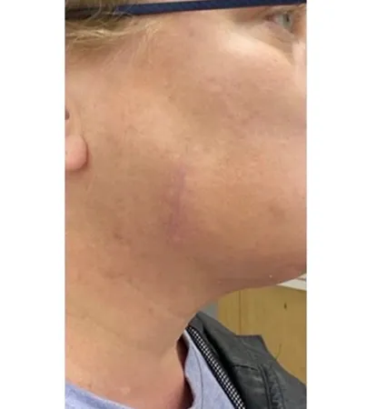 profractional-scars-pat-2-01