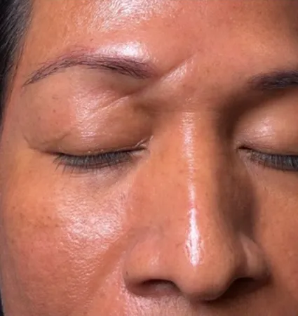 profractional-scars-pat-3-01