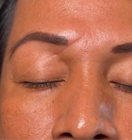 profractional-scars-pat-3-02