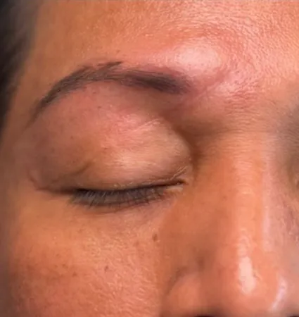 profractional-scars-pat-3-03