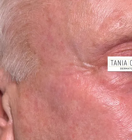 profractional-trl-pat-B-02