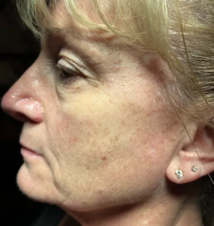 sculptra-pat-4-01