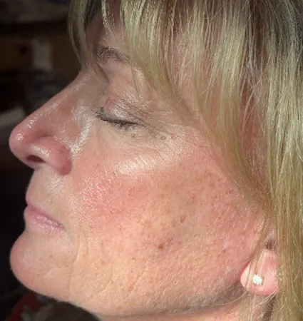 sculptra-pat-4-02