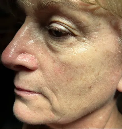 sculptra-pat-4-03