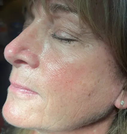 sculptra-pat-4-04