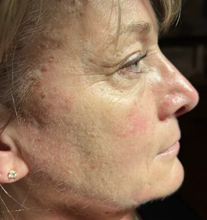 sculptra-pat-4-05