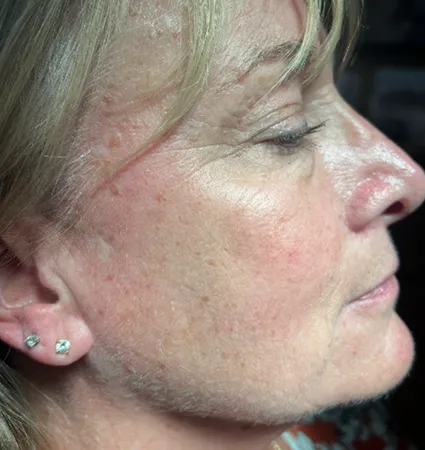 sculptra-pat-4-06