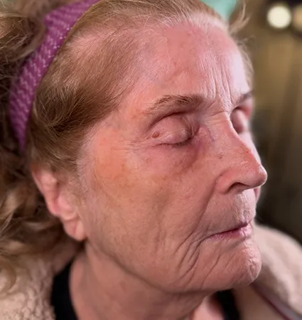 tranformation_botox-fillers-80yrs-01