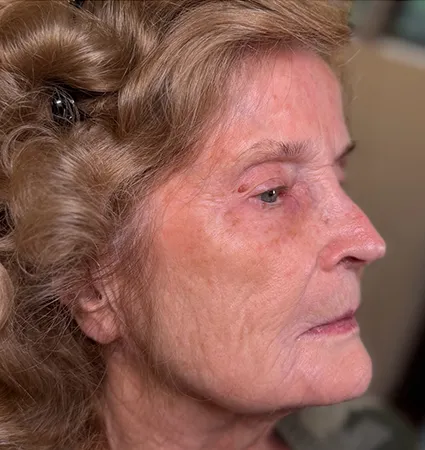 tranformation_botox-fillers-80yrs-02