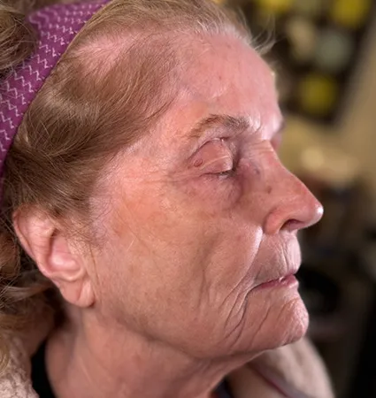 tranformation_botox-fillers-80yrs-03