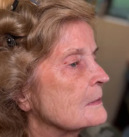 tranformation_botox-fillers-80yrs-04